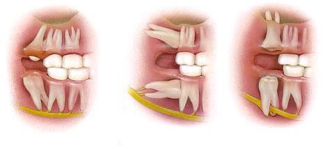 Mọc răng khôn uống thuốc gì giảm đau nhanh và hiệu quả? 1