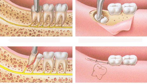 Nhổ răng khôn có đau không có ảnh hưởng đến sức khỏe không? 2