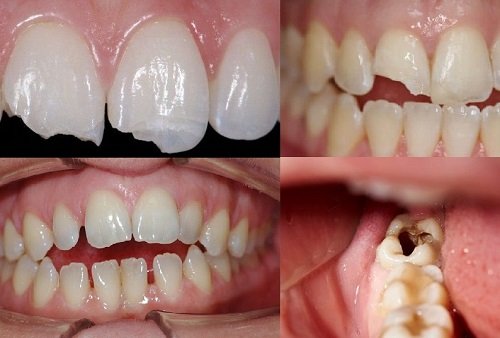 Trước và sau quá trình trám răng nên ăn gì? 1