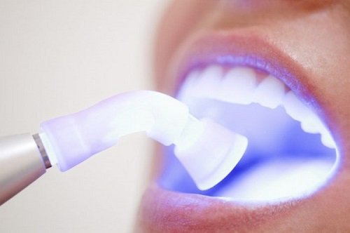 Tẩy trắng răng bằng đèn plasma có hại không? Tìm hiểu kỹ thông tin 1