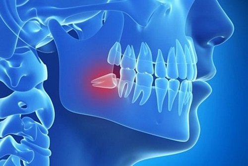 Đau răng khôn dẫn đến đau tai - Cách khắc phục tình trạng 1