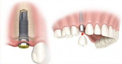 Trẻ em có trồng răng implant được không? 2