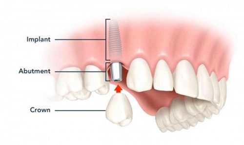 Trẻ em có trồng răng implant được không? 3