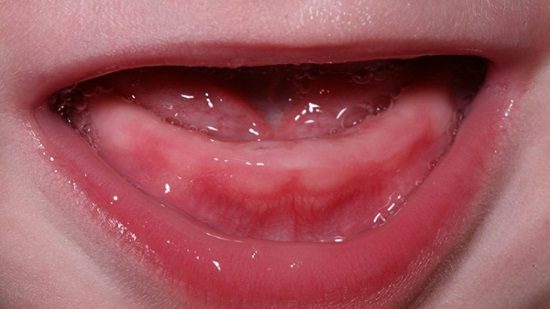 Mọc răng hàm ở trẻ em diễn ra như thế nào? 1